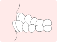 下顎前突（反対咬合）