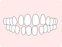 空隙歯列